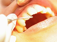 虫歯や歯周病の検査