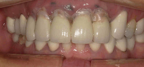 前歯部インプラント＋臼歯部セラミック治療 口腔内
