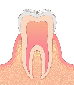 むし歯の進行段階C-0