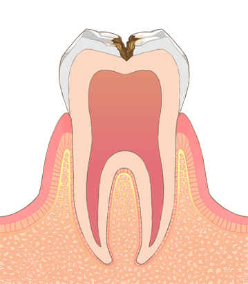 むし歯の進行段階C-2