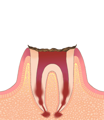 むし歯の進行段階C-4