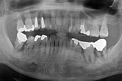 GBR・骨誘導再生法 術前