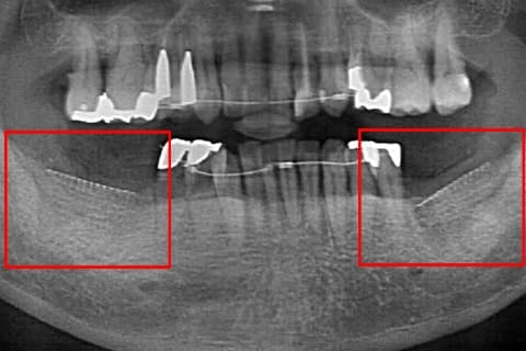 GBR・骨誘導再生法 術後