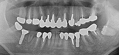 前歯部インプラント＋臼歯部セラミック治療 パノラマレントゲン