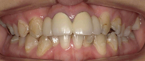 前歯部インプラント治療 口腔内