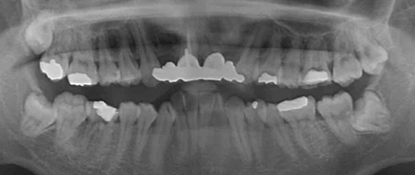前歯部インプラント治療 パノラマレントゲン