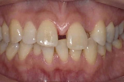 すきっ歯インビザライン・マウスピース矯正 術前