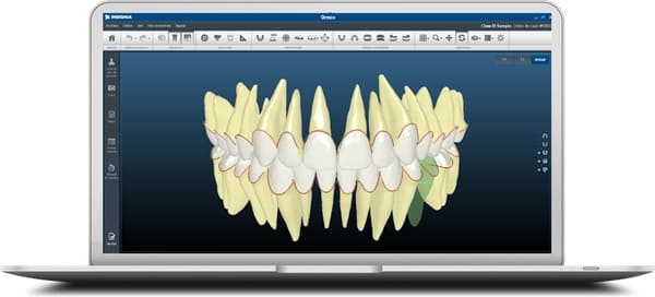 3Dデジタル矯正治療「インシグニア」を導入