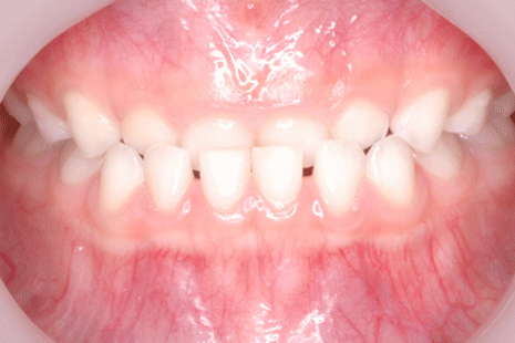 乳歯の反対咬合