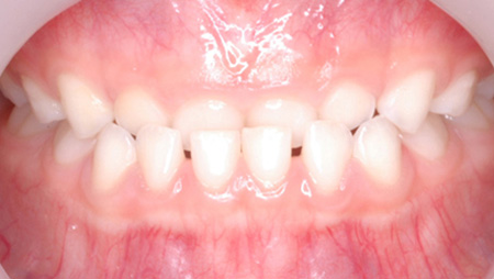 乳歯の反対咬合 術前