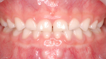 乳歯の反対咬合 術後