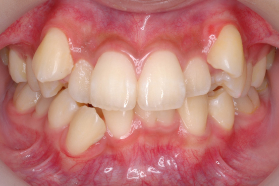 八重歯の治療 術前